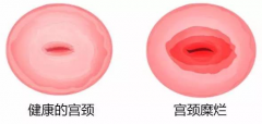 宫颈糜烂与性生活关系密切吗？