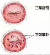 宫颈囊肿疾病怎么诊断？