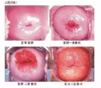 宫颈糜烂一度二度三度图片