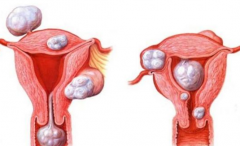 外阴左侧长了个硬疙瘩？
