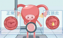 宫颈疾病的治疗？