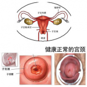 轻度宫颈糜烂需要治疗？