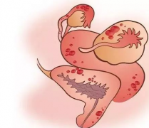 盆腔炎会影响到女性生育能力吗?