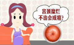 妇科医院分析宫颈糜烂护理方法？
