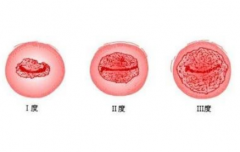 宫颈糜烂不同程度怎么治疗？