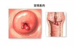 女性为什么会长宫颈息肉？
