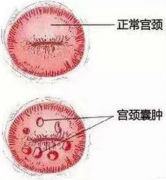 宫颈囊肿会出血吗？