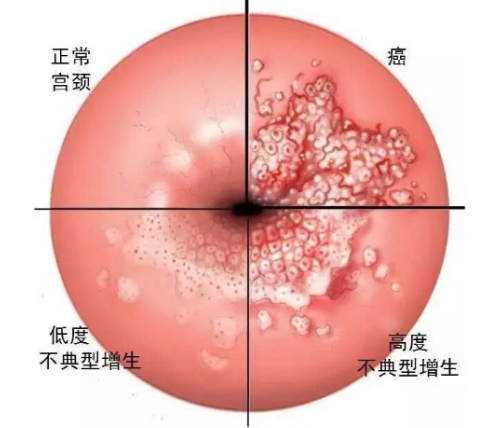 宫颈糜烂怎么形成的 如何自查？