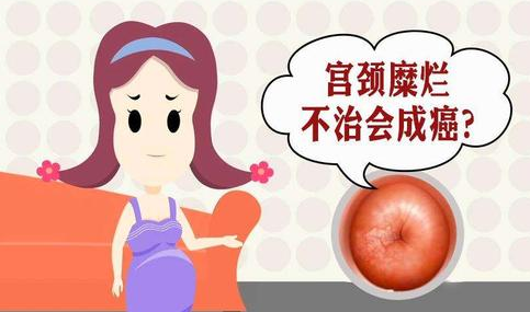 宫颈糜烂到底严不严重？不治自己会好吗？