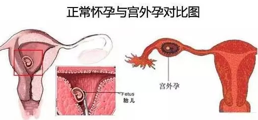 宫外孕应该怎么办？