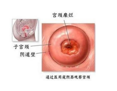 宫颈糜烂有多长潜伏期?